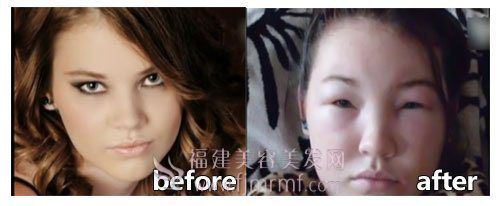 少女染发(fā)过敏(mǐn)前后对比 少女染发过敏前后(hòu)对(duì)比
